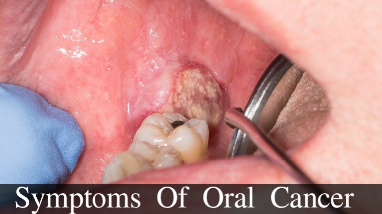 Oral Cancer: Understanding Risks, Early Signs, and Preventive Measures for a Healthier Future